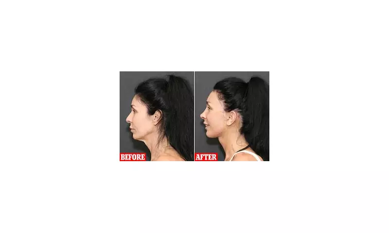 Mother's Dramatic Facelift Before Son's Wedding Sparks Debate on Beauty Standards