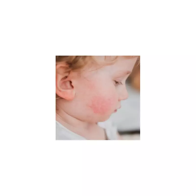 Parents' Horror as Babies Develop Blistering Skin Condition – Experts Warn of Rising Cases