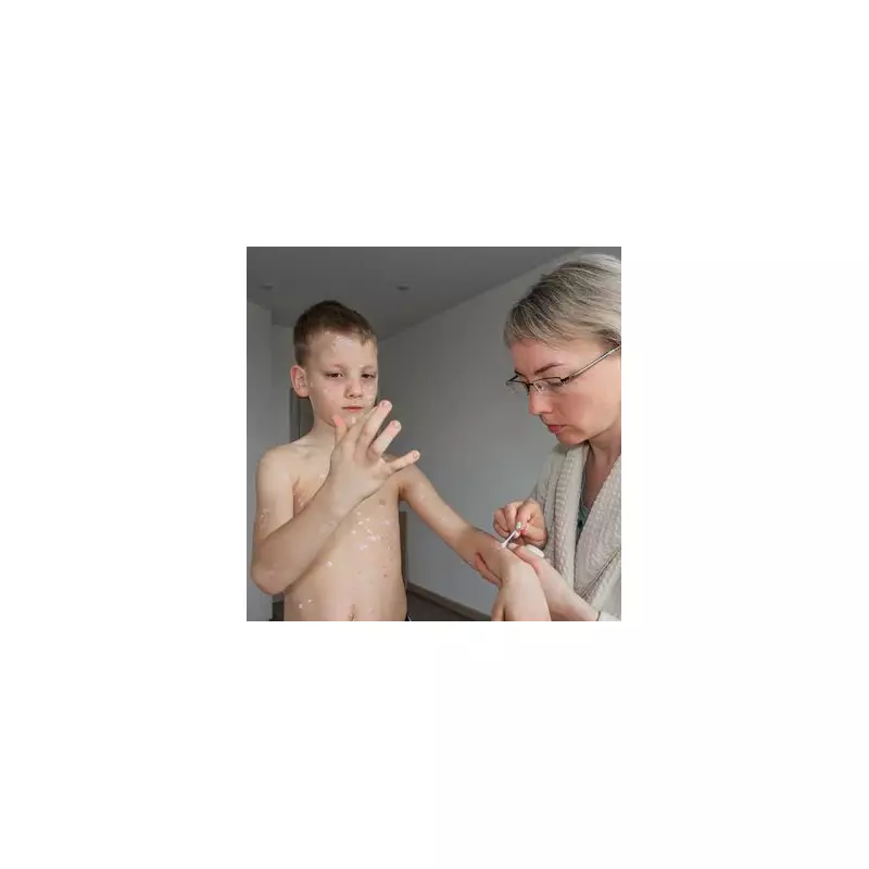 UK Measles Outbreak: Hotspots Revealed as Cases Surge – Is Your Area Affected?