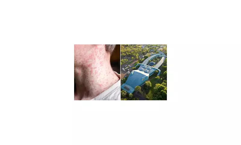 Urgent Health Alert: Measles Outbreak Strikes Northern Territory – Symptoms and Safety Measures
