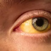 Dark Urine and Fatigue? The Little-Known Illness You Might Be Ignoring