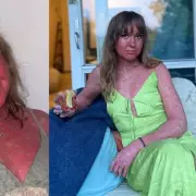 Living with Peeling Skin: One Woman's Battle with a Rare Condition