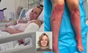 Nurse Faces Jail After Husband Suffers Severe Burns in Shocking Firepit Incident