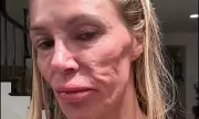 Real Housewives Star Brandi Glanville Reveals Shocking Parasite Infection That Left Her Face Disfigured