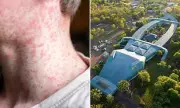 Urgent Health Alert: Measles Outbreak Strikes Northern Territory – Symptoms and Safety Measures