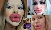 Woman With The World's Biggest Lips Reveals Shocking Transformation After More Surgery