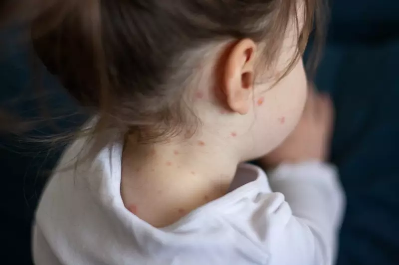 Chickenpox Vaccine on NHS: UK Parents Urged to Recognise Symptoms as Rollout Begins
