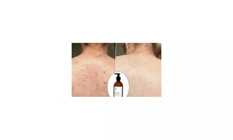Dermatologist-Approved Body Wash for Acne: The £19.99 Solution for Clearer Skin