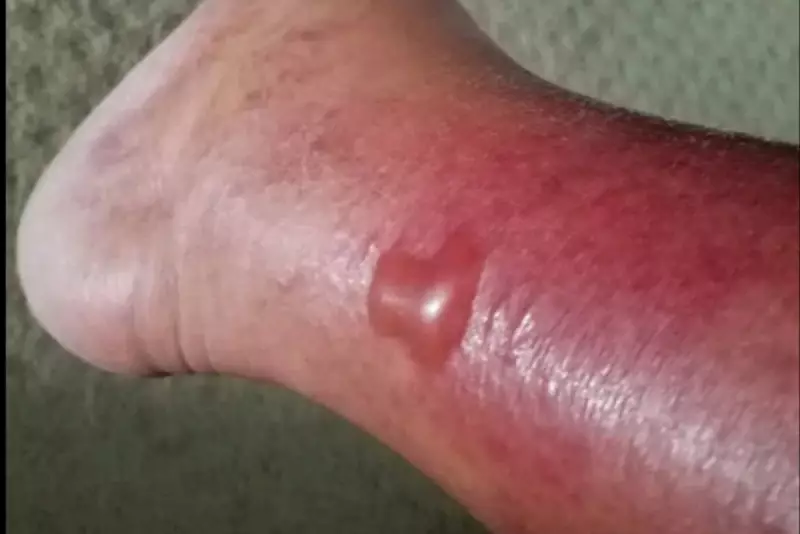 Flesh-Eating Bacteria Warning: UK Health Agency Issues Urgent Alert for Coastal Waters