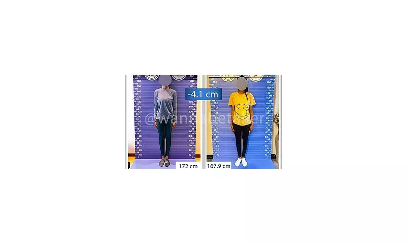 Leg-Lengthening in Reverse: The Alarming New Trend of 'Height Reduction' Surgery in Turkey | UK Women Among Those Seeking Drastic Procedure