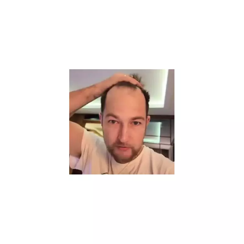 Man, 35, Shocked by £3,220 Hair Transplant Bill – But Was It Worth It?