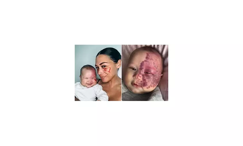 Mother Defends Controversial Laser Treatment on Baby's Birthmark – See the Stunning Results 3 Years Later