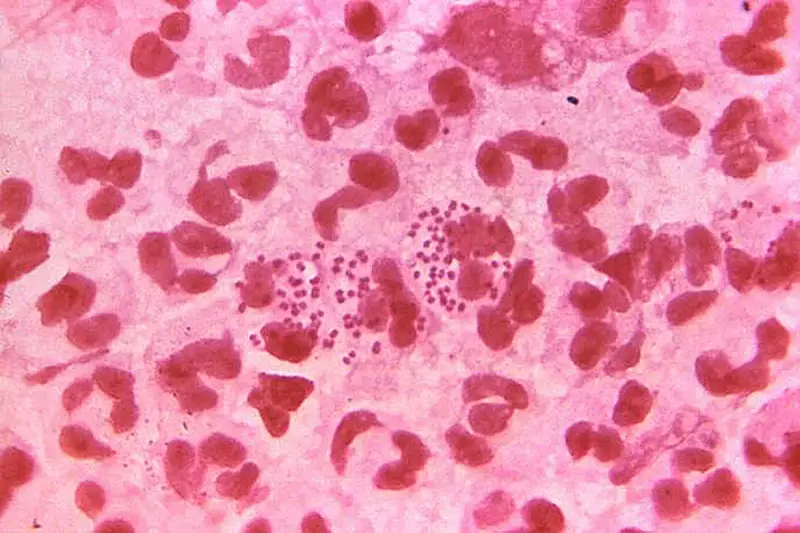 NHS England to Offer Free Gonorrhoea Vaccine in World-First Initiative