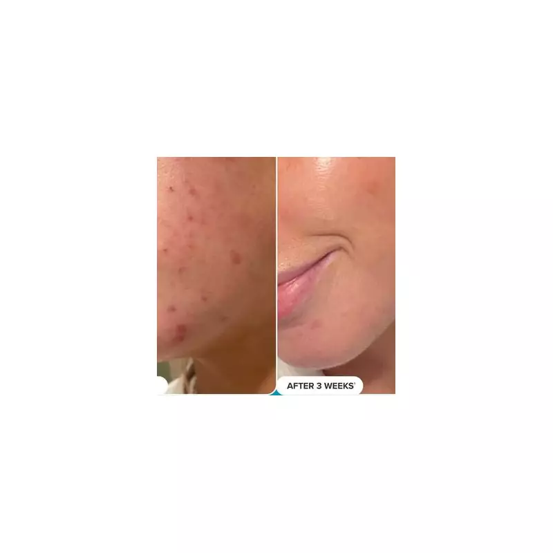 Revolutionary BHA Toner Pads: The Ultimate Travel Skincare Solution for Flawless Complexion