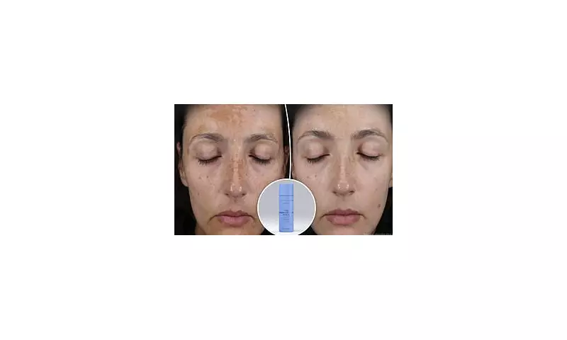 This 'Magic' Pigmentation Serum Sold Out in Just 2 Minutes – Now Back in Stock & Transforming Skin in Weeks!