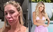 Dermatologist Shocked as Brandi Glanville Reveals Parasite Mystery Behind Her Baffling Facial Condition