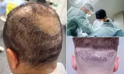 Hair Transplant Horror: UK Men Left 'Disfigured & Depressed' By Botched Procedures, Experts Warn