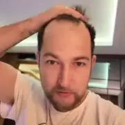 Man, 35, Shocked by £3,220 Hair Transplant Bill – But Was It Worth It?