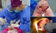 Pioneering UK Surgeons Successfully Transplant Genetically Modified Pig Lung into Human Recipient in World-First Operation