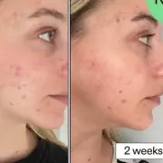 Revolutionary Anti-Blemish Serum Promises Clear Skin in Just 7 Days – Here's How It Works
