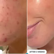 Revolutionary BHA Toner Pads: The Ultimate Travel Skincare Solution for Flawless Complexion