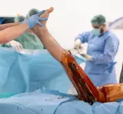 The Painful Pursuit of Height: Why Some Men Are Breaking Their Legs to Grow Taller