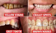 What Your Tooth Colour Reveals About Your Health – Science Explains