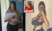 Woman's Shocking Transformation: Rare Condition Causes Sudden Breast Growth Overnight