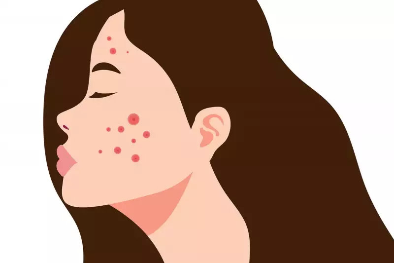 Adult Acne Breakthrough: Expert Dermatologist Reveals Top Treatments for Stubborn Spots