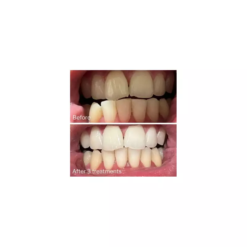 Dentist's 95p Teeth Whitening Secret: Supermarket Product Rivals £300 Treatments