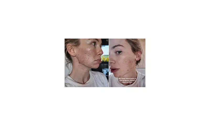 Georgia 'Toff' Toffolo Reveals Relentless Acne Battle: 'My Biggest Life Struggle' | Exclusive