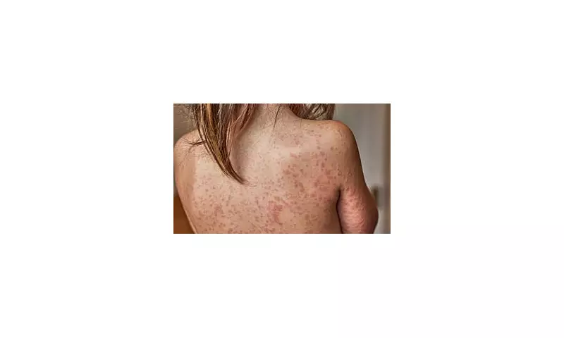 Measles Alert: Health Officials Confirm Case in New York City Amid Fears of Outbreak