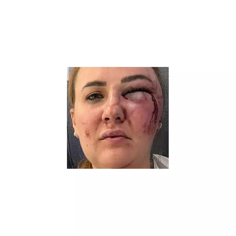 My Boyfriend Left Me Looking Like a 'Zombie' After Botched DIY Lip Filler Injection