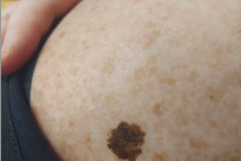 NHS Deploys Revolutionary AI to Transform Skin Cancer Detection