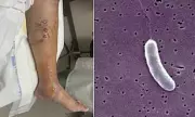Deadly Flesh-Eating Bacteria Found in Louisiana Waters: Health Officials Issue Urgent Warning