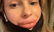 Lip Filler Nightmare: UK Woman's Warning After 'Sausage Lips' Ordeal Goes Viral