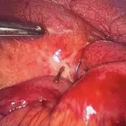 Man's Agonising 5-Year Mystery Pain Caused by Hidden Toothbrush Bristle | NHS Warning