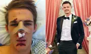 Married At First Sight UK Groom Hospitalised After Brutal Attack: Cheekbone Fractured & Teeth Shattered