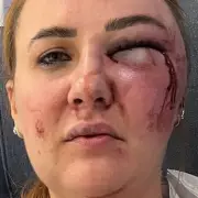 My Boyfriend Left Me Looking Like a 'Zombie' After Botched DIY Lip Filler Injection