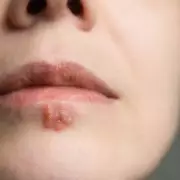 NHS Doctor Reveals: The Truth About Cellulite and Why You Can't Simply 'Get Rid' of It