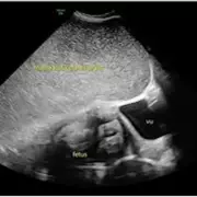 Pregnant Mum's 'Indigestion' Turns Out to Be Labour in Shocking 30-Week Surprise | UK Maternity Alert