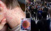 Sydney Measles Alert: Health Officials Urge Vigilance After Confirmed Case in Western Sydney
