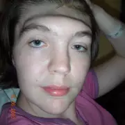 Woman's Forehead Miraculously Rebuilt After Cancer Nightmare | UK Medical Breakthrough