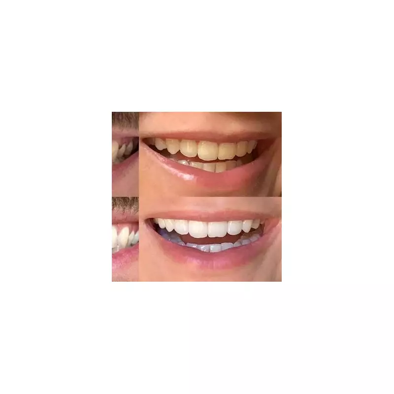 Amazon Prime Day Dental Deal: My Sweet Smile Teeth Whitening Kit Slashed by 75%