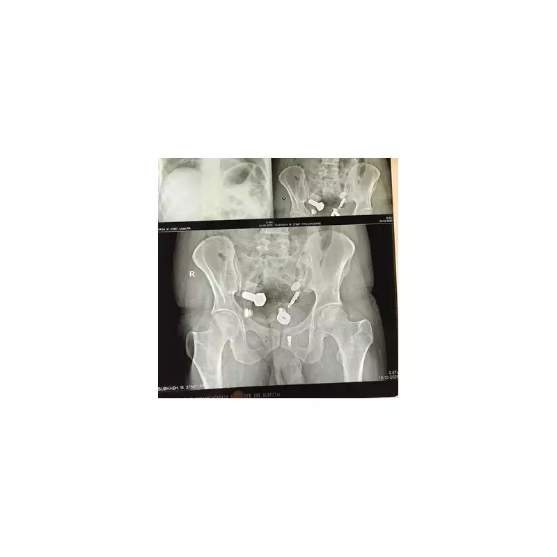 Mystery Tummy Ache Turns Out To Be Rare Tapeworm Infection In UK Patient