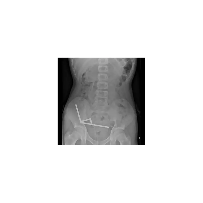 Teen's Horror E-Scooter Crash Sparks Major Surgery After Wheel Detaches Mid-Ride