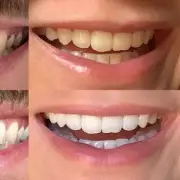 Amazon Prime Day Dental Deal: My Sweet Smile Teeth Whitening Kit Slashed by 75%