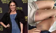 Former Bachelorette Georgia Love Reveals Mysterious Leg Bruises Sparking Health Concerns
