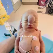 Miracle Baby Born With Rare Tumour The Size Of An ORANGE Defies All Odds