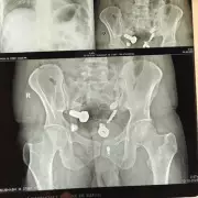 Mystery Tummy Ache Turns Out To Be Rare Tapeworm Infection In UK Patient